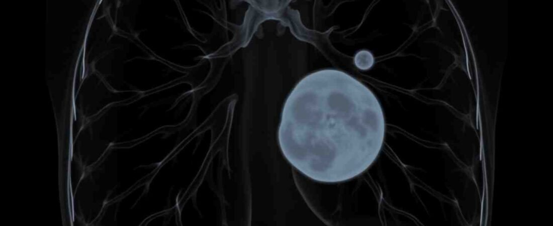 La IA en la curación del cáncer ¿Ficción o una realidad de 2035?