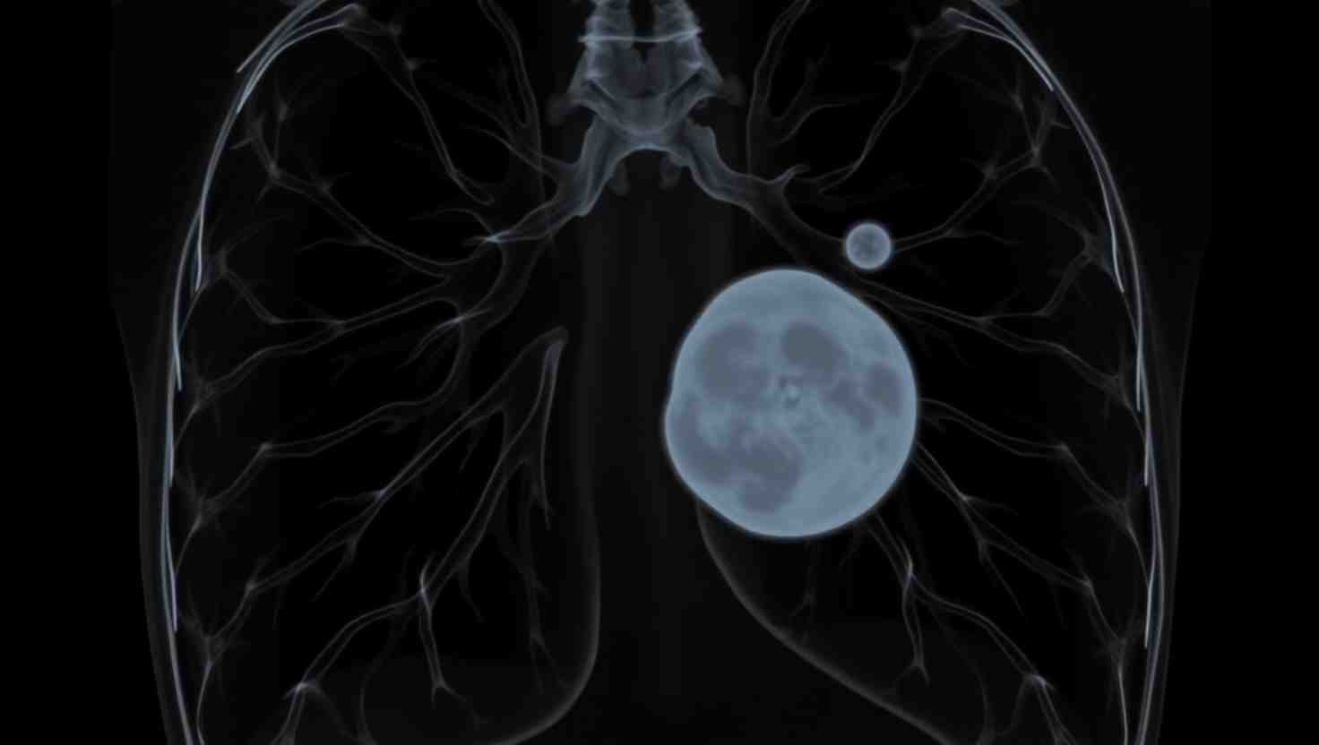 La IA en la curación del cáncer ¿Ficción o una realidad de 2035?
